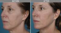 Chicago Laser Skin Tightening
